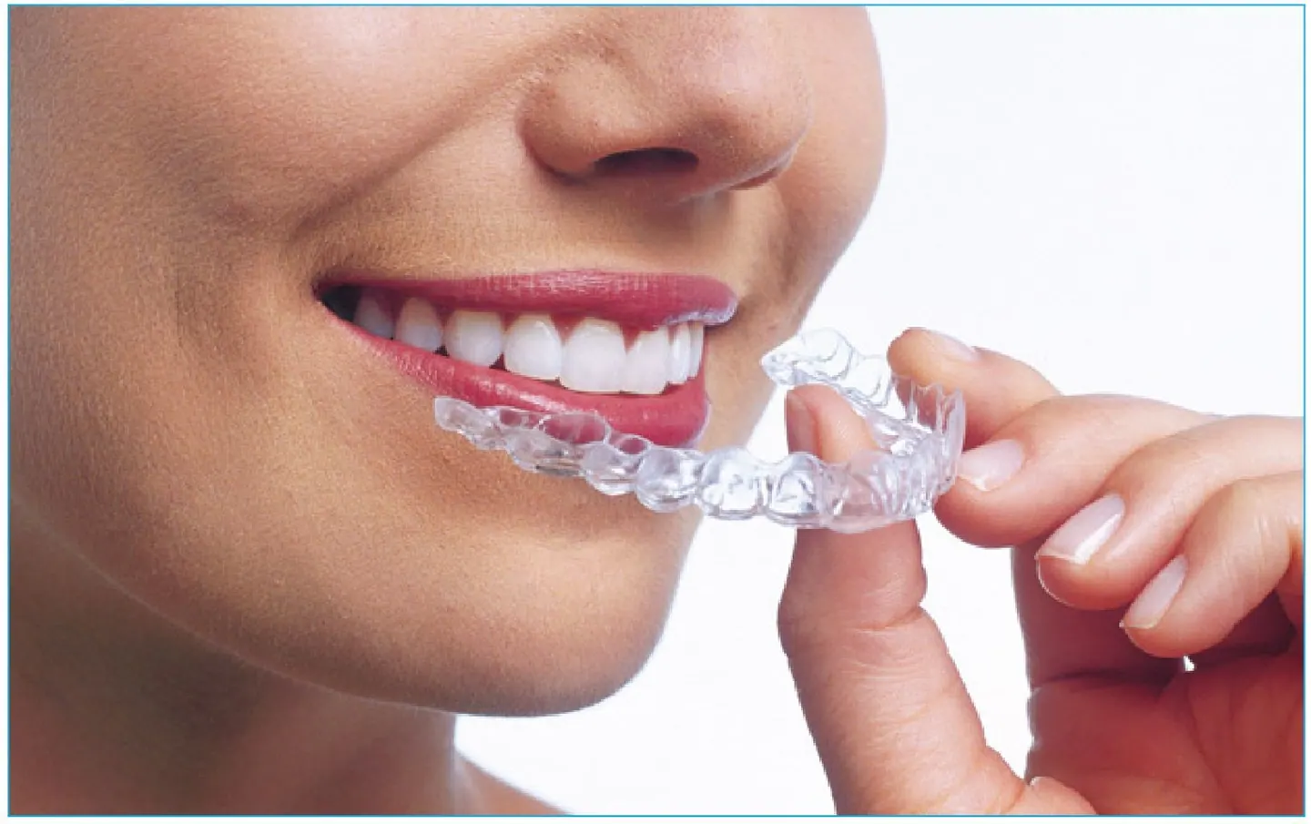 A clear aligner used in orthodontic treatment