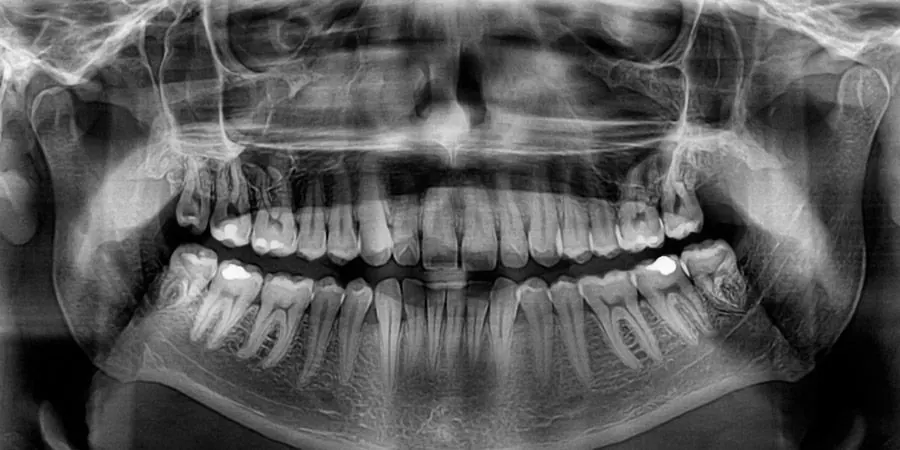 A digital panoramic dental X-ray